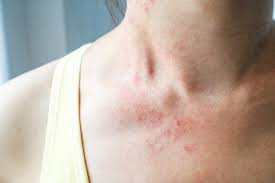 Healing Eczema Naturally